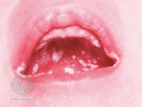 Oral thrush